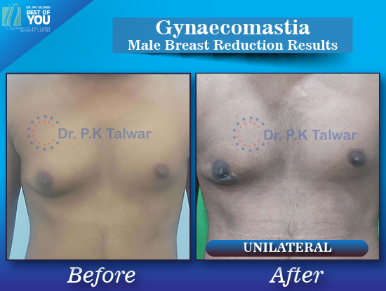 Gynaecomastia before after image